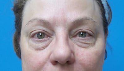 Eyelid Surgery Before & After Gallery - Patient 164404 - Image 1