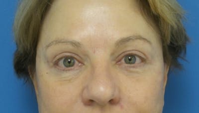 Eyelid Surgery Before & After Gallery - Patient 164404 - Image 2
