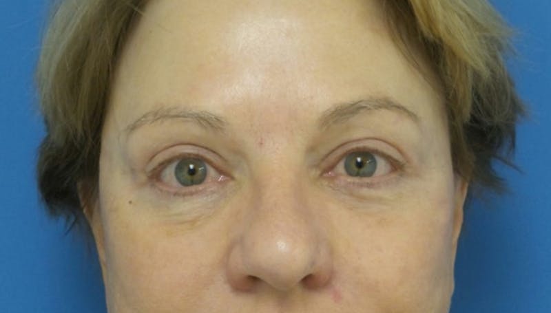 Eyelid Surgery Before & After Gallery - Patient 164404 - Image 2