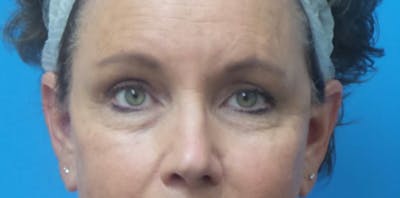 Eyelid Surgery Before & After Gallery - Patient 168924 - Image 1