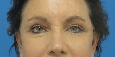 Eyelid Surgery Before & After Gallery - Patient 168924 - Image 2