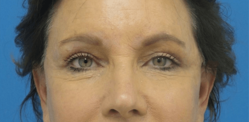 Eyelid Surgery Before & After Gallery - Patient 168924 - Image 2