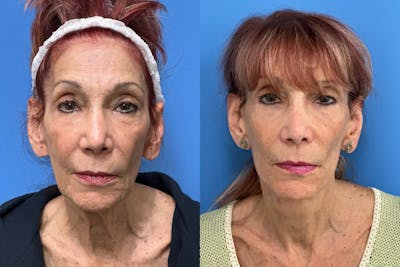Facelift Before & After Gallery - Patient 134433 - Image 1