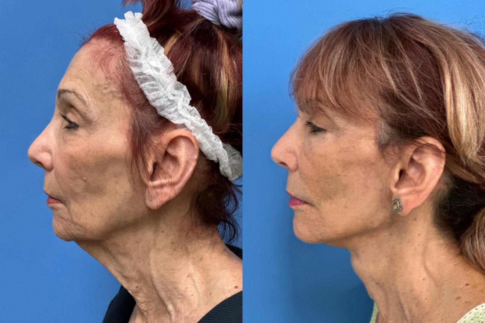 Facelift Before & After Gallery - Patient 134433 - Image 2