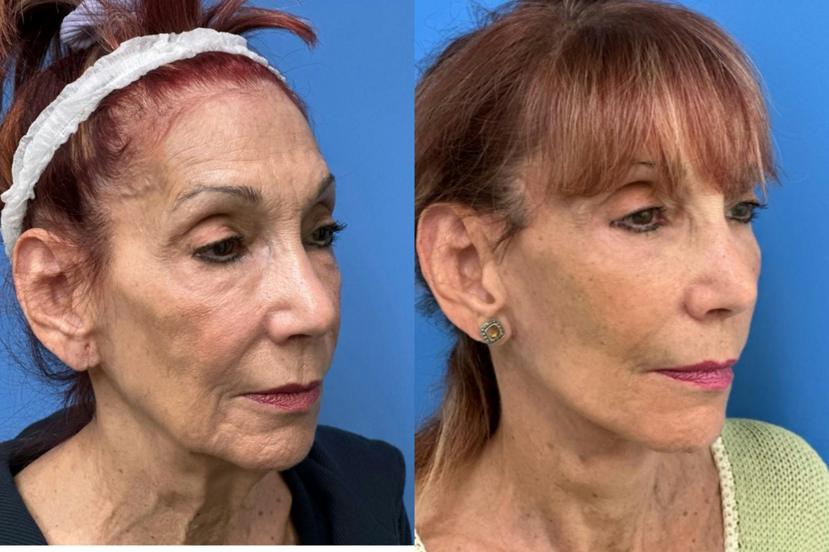 Facelift Before & After Gallery - Patient 134433 - Image 3