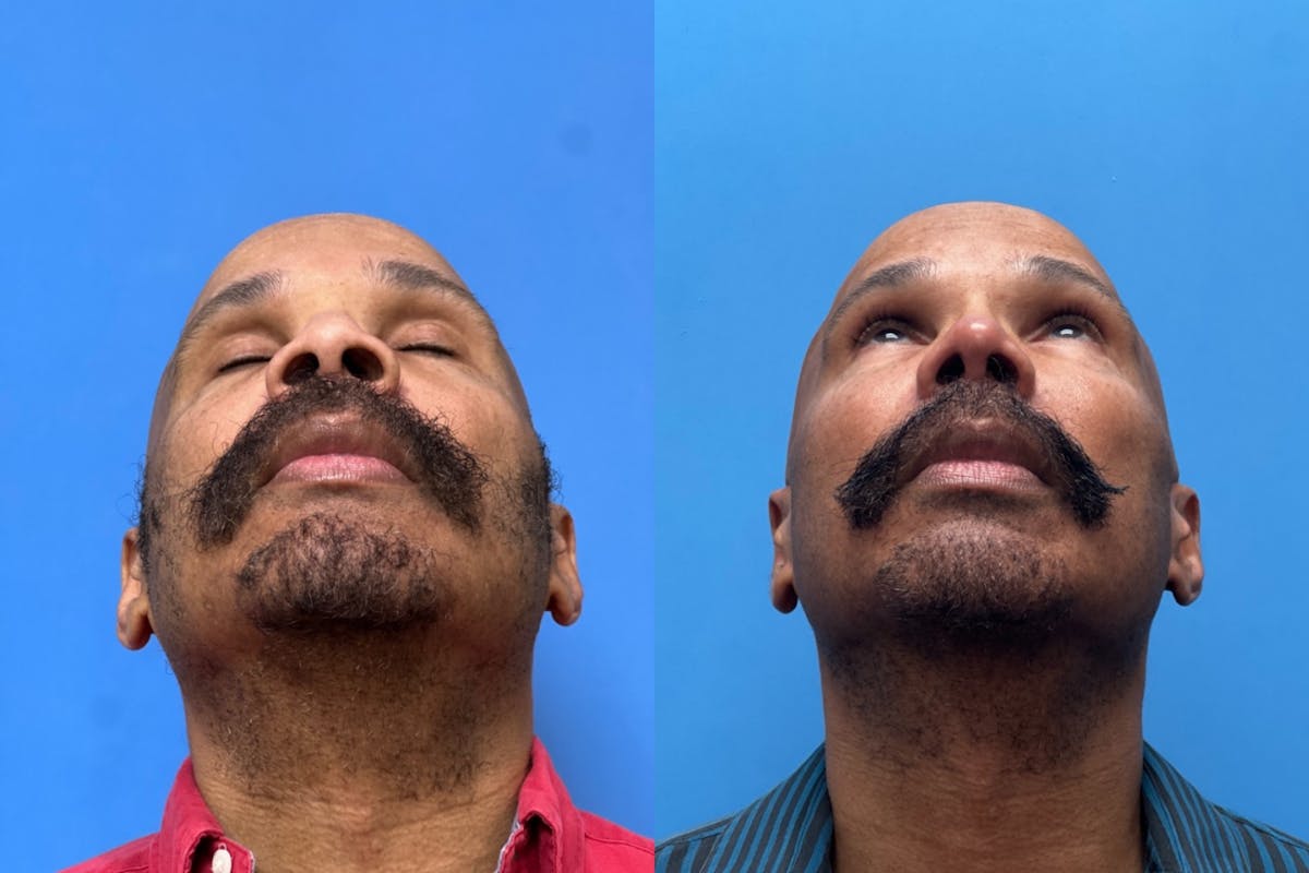 Rhinoplasty Before & After Gallery - Patient 124418 - Image 4