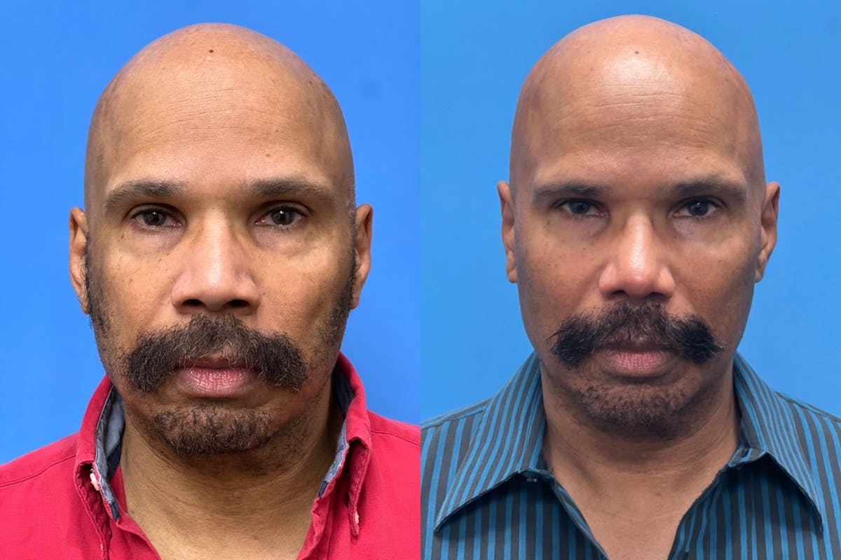 Rhinoplasty Before & After Gallery - Patient 124418 - Image 3