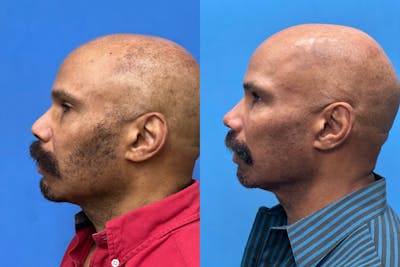 Rhinoplasty Before & After Gallery - Patient 124418 - Image 1