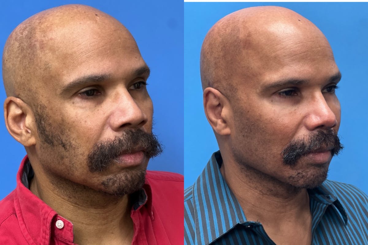 Rhinoplasty Before & After Gallery - Patient 124418 - Image 2