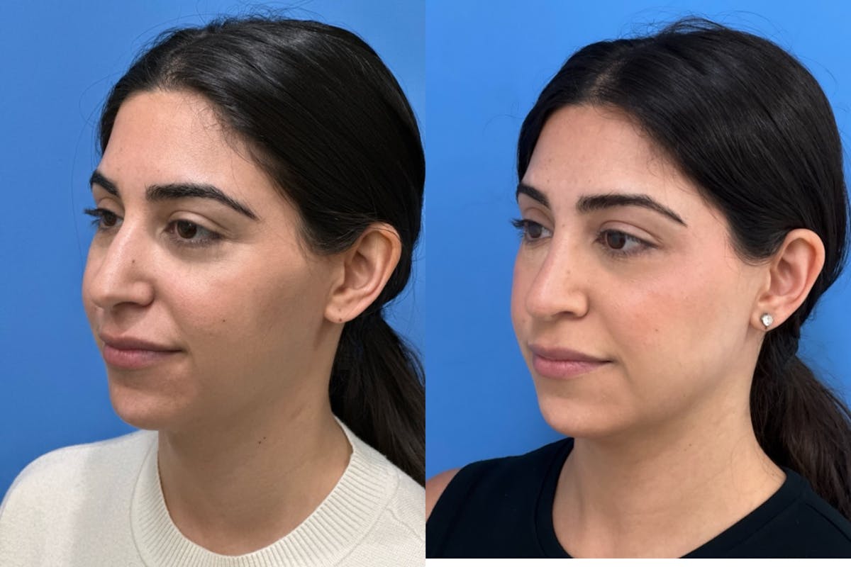 Rhinoplasty Before & After Gallery - Patient 136987 - Image 2