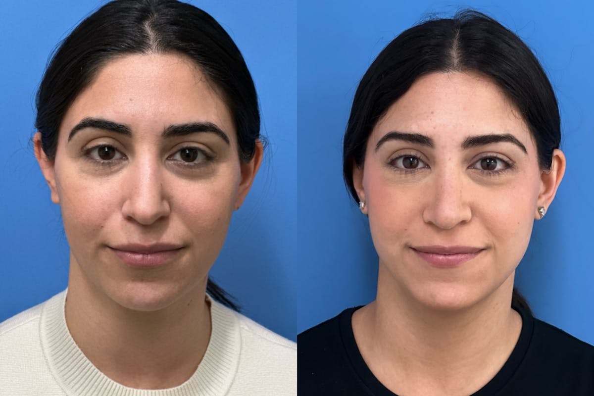 Rhinoplasty Before & After Gallery - Patient 136987 - Image 3