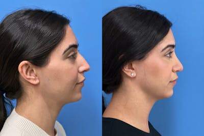 Rhinoplasty Before & After Gallery - Patient 136987 - Image 1