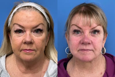 Facelift Before & After Gallery - Patient 224324 - Image 1