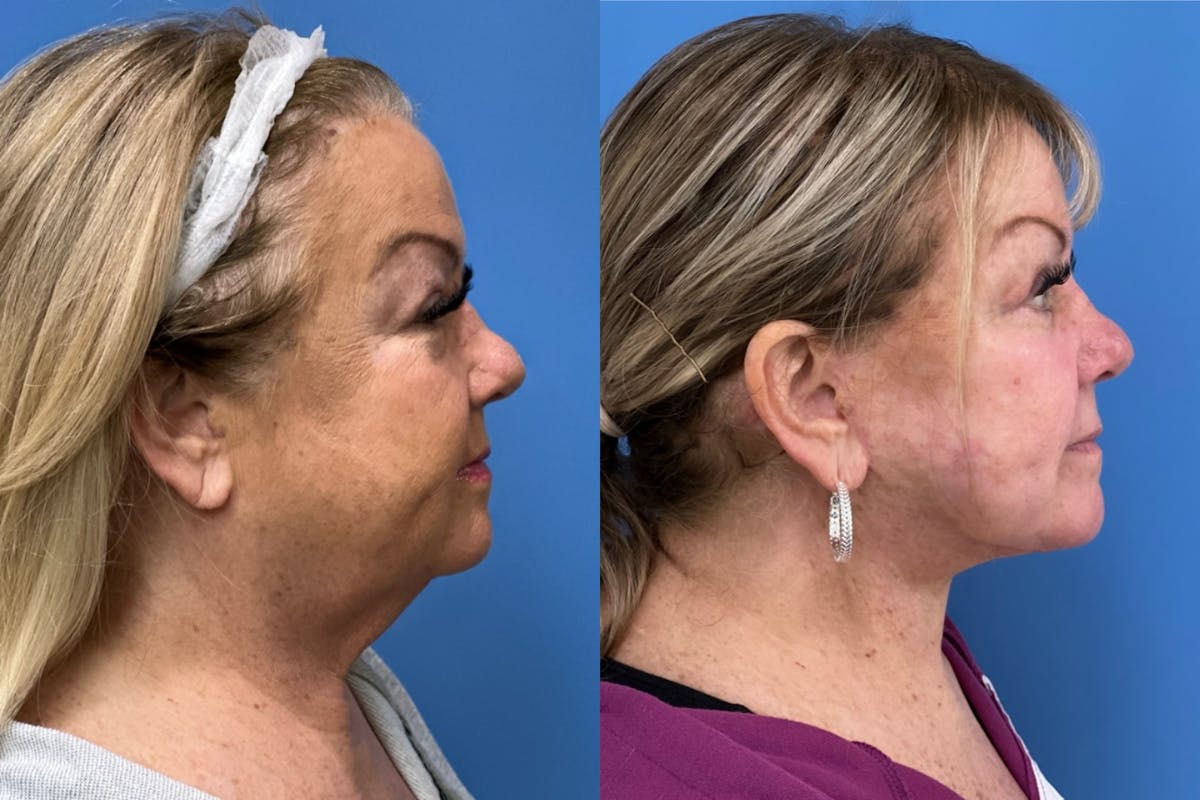 Facelift Before & After Gallery - Patient 224324 - Image 3