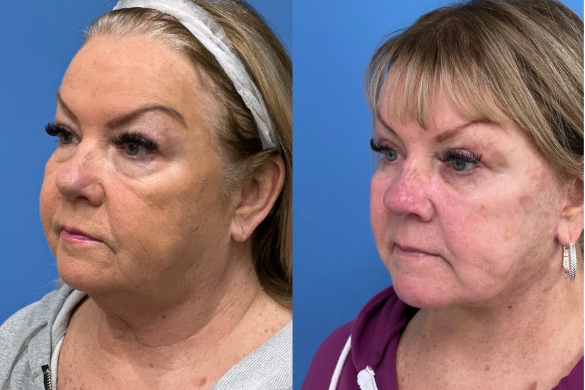 Facelift Before & After Gallery - Patient 224324 - Image 2