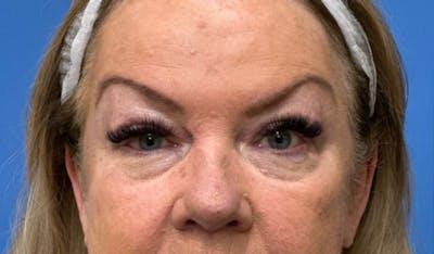 Eyelid Surgery Before & After Gallery - Patient 227035 - Image 1