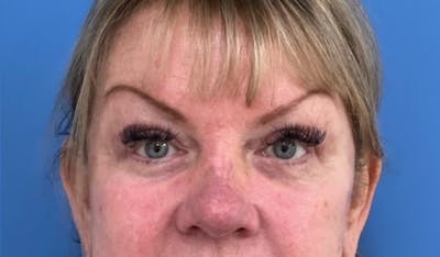 Eyelid Surgery Before & After Gallery - Patient 227035 - Image 2