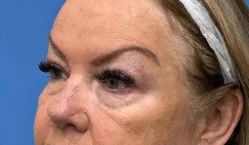 Eyelid Surgery Before & After Gallery - Patient 227035 - Image 3