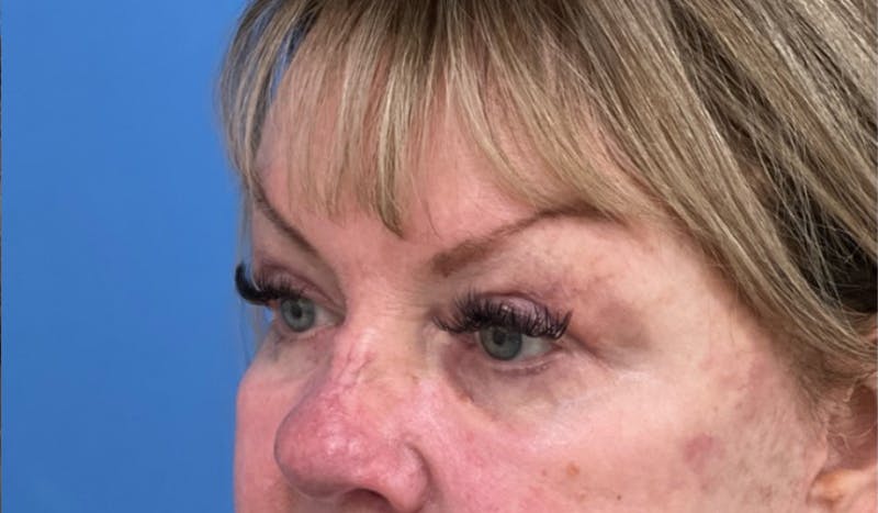 Eyelid Surgery Before & After Gallery - Patient 227035 - Image 4