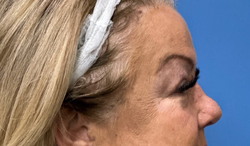 Eyelid Surgery Before & After Gallery - Patient 227035 - Image 5