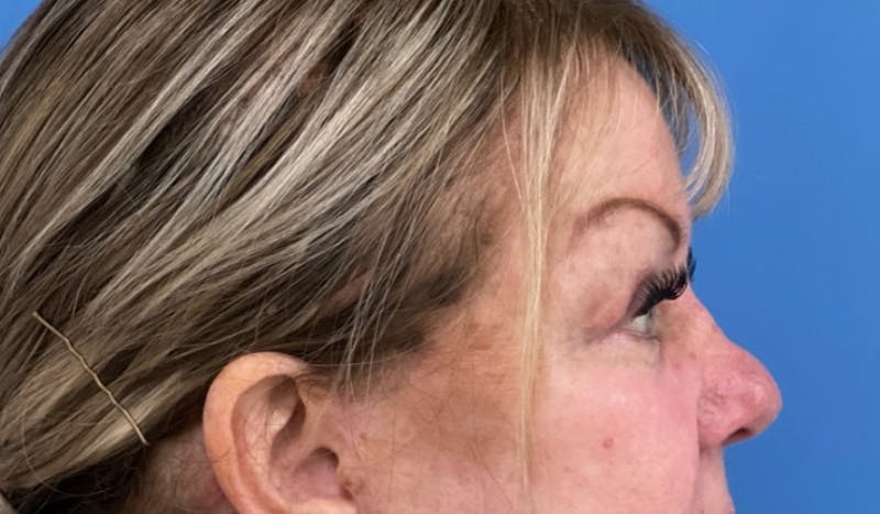 Eyelid Surgery Before & After Gallery - Patient 227035 - Image 6