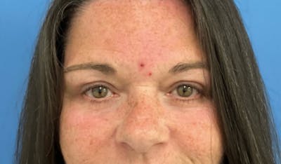 Eyelid Surgery Before & After Gallery - Patient 352012 - Image 2