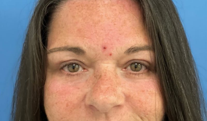 Eyelid Surgery Before & After Gallery - Patient 352012 - Image 2