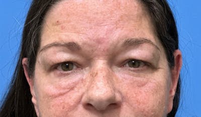 Eyelid Surgery Before & After Gallery - Patient 352012 - Image 1