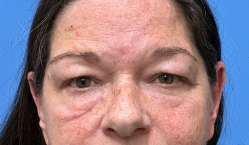 Eyelid Surgery Before & After Gallery - Patient 352012 - Image 1