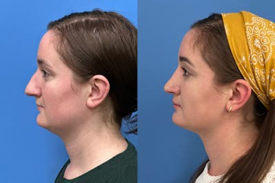 Rhinoplasty Before & After Gallery - Patient 243672 - Image 1