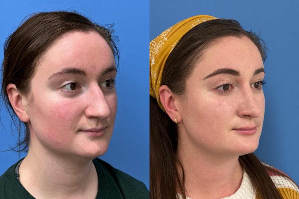 Rhinoplasty Before & After Gallery - Patient 243672 - Image 2