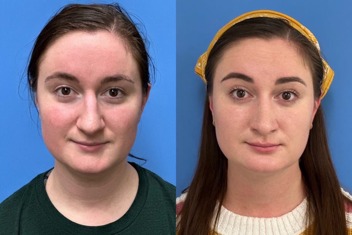 Rhinoplasty Before & After Gallery - Patient 243672 - Image 3