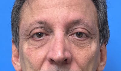 Eyelid Surgery Before & After Gallery - Patient 138212 - Image 1