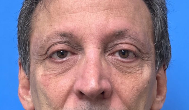 Eyelid Surgery Before & After Gallery - Patient 138212 - Image 1