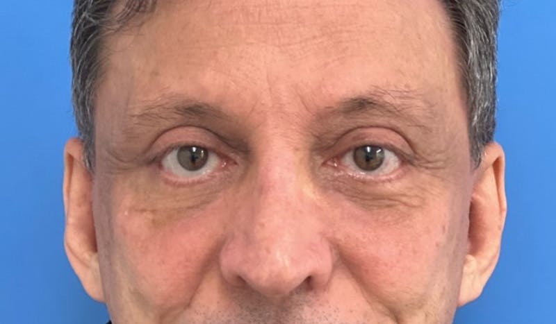 Eyelid Surgery Before & After Gallery - Patient 138212 - Image 2