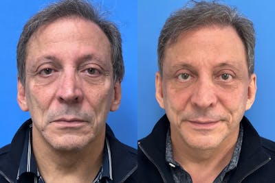 Brow Lift Before & After Gallery - Patient 396194 - Image 1