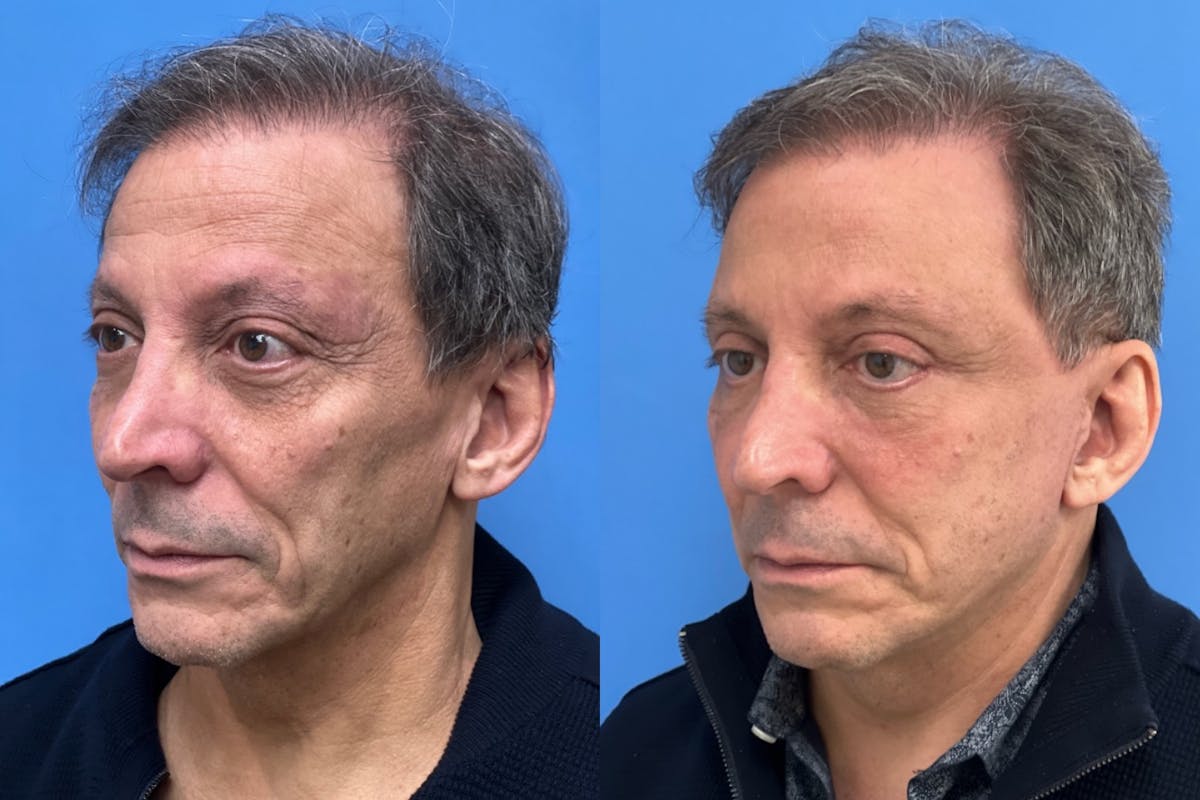 Facelift Before & After Gallery - Patient 198371 - Image 2