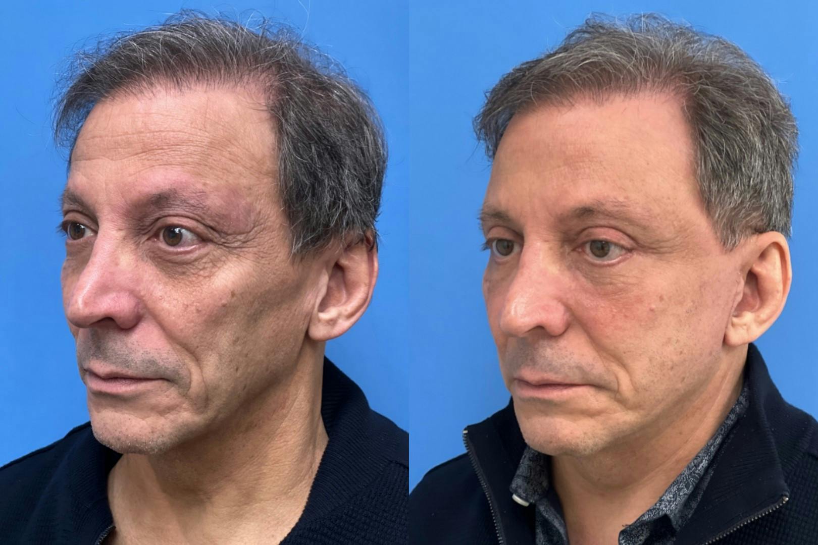 Brow Lift Before & After Gallery - Patient 396194 - Image 2