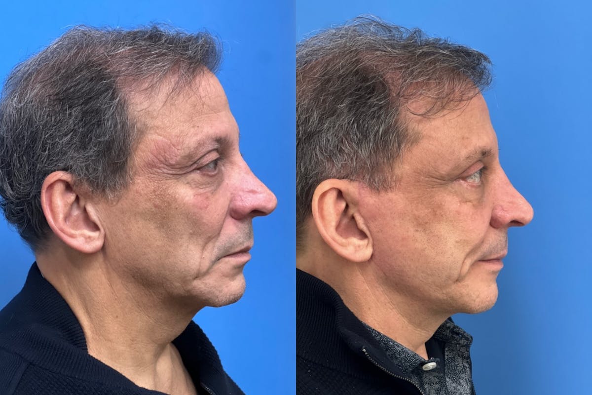 Facelift Before & After Gallery - Patient 198371 - Image 3