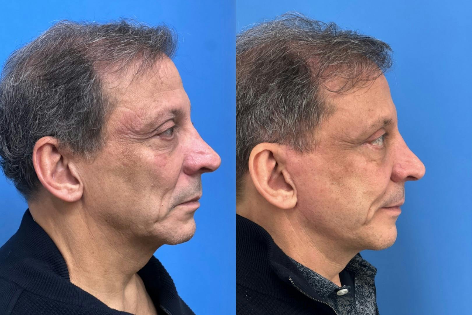 Brow Lift Before & After Gallery - Patient 396194 - Image 3