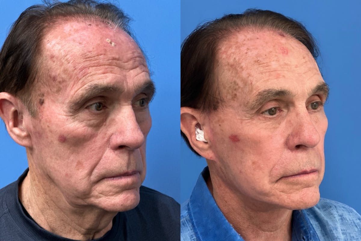 Neck Lift Before & After Gallery - Patient 180071 - Image 2