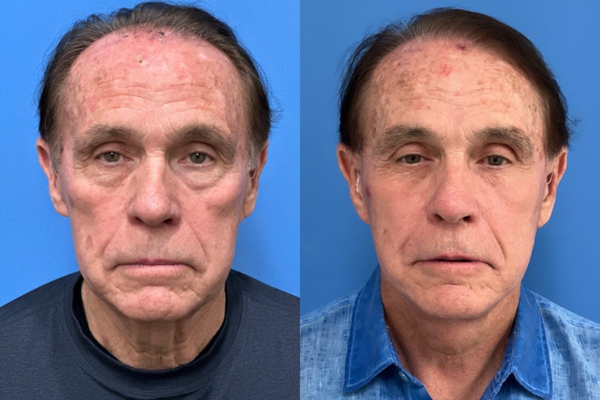 Neck Lift Before & After Gallery - Patient 180071 - Image 1