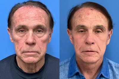 Neck Lift Before & After Gallery - Patient 180071 - Image 1
