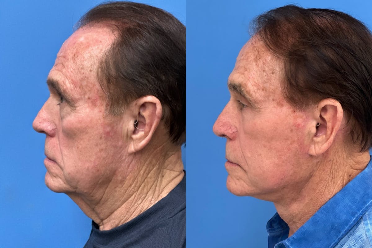Neck Lift Before & After Gallery - Patient 180071 - Image 3