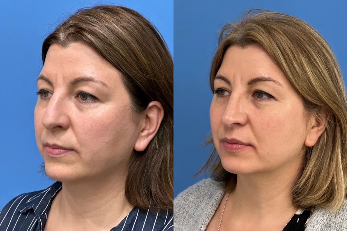 Rhinoplasty Before & After Gallery - Patient 300152 - Image 2