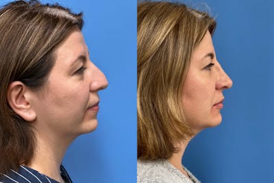 Rhinoplasty Before & After Gallery - Patient 300152 - Image 1