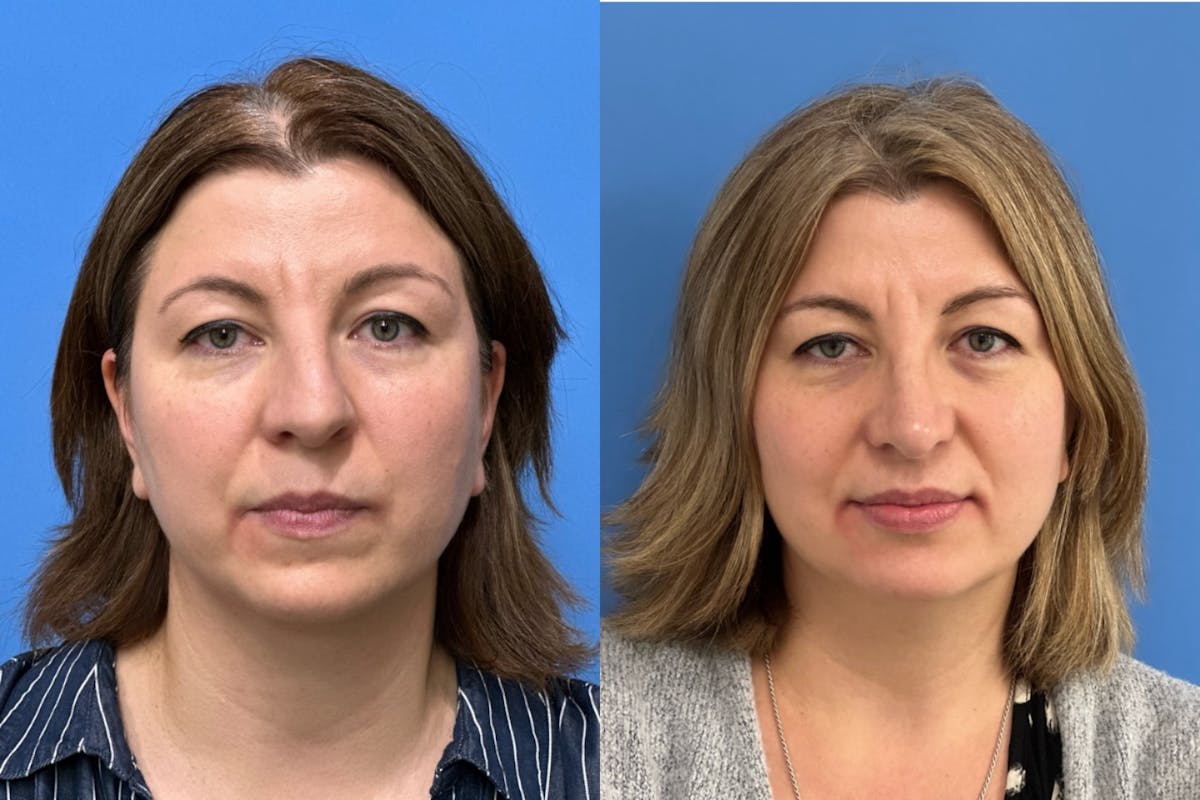 Rhinoplasty Before & After Gallery - Patient 300152 - Image 3