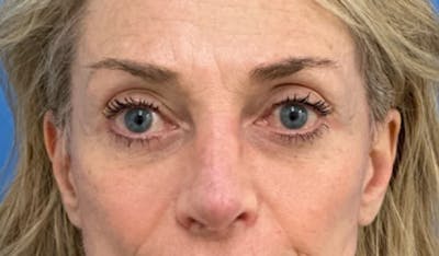 Eyelid Surgery Before & After Gallery - Patient 405473 - Image 2