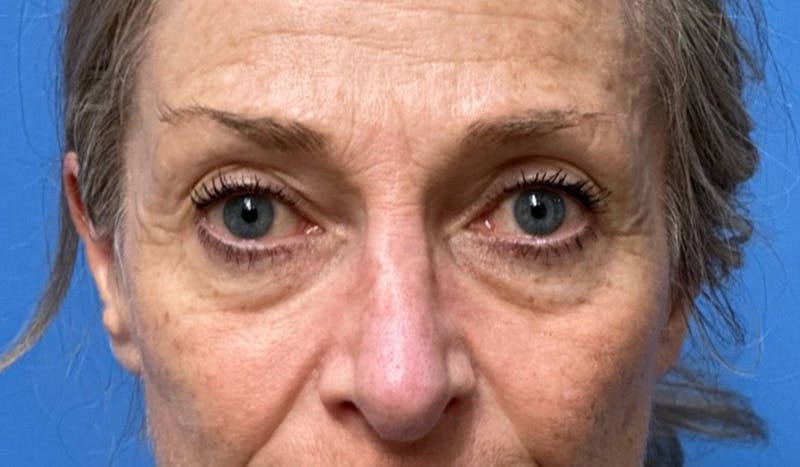 Eyelid Surgery Before & After Gallery - Patient 405473 - Image 1