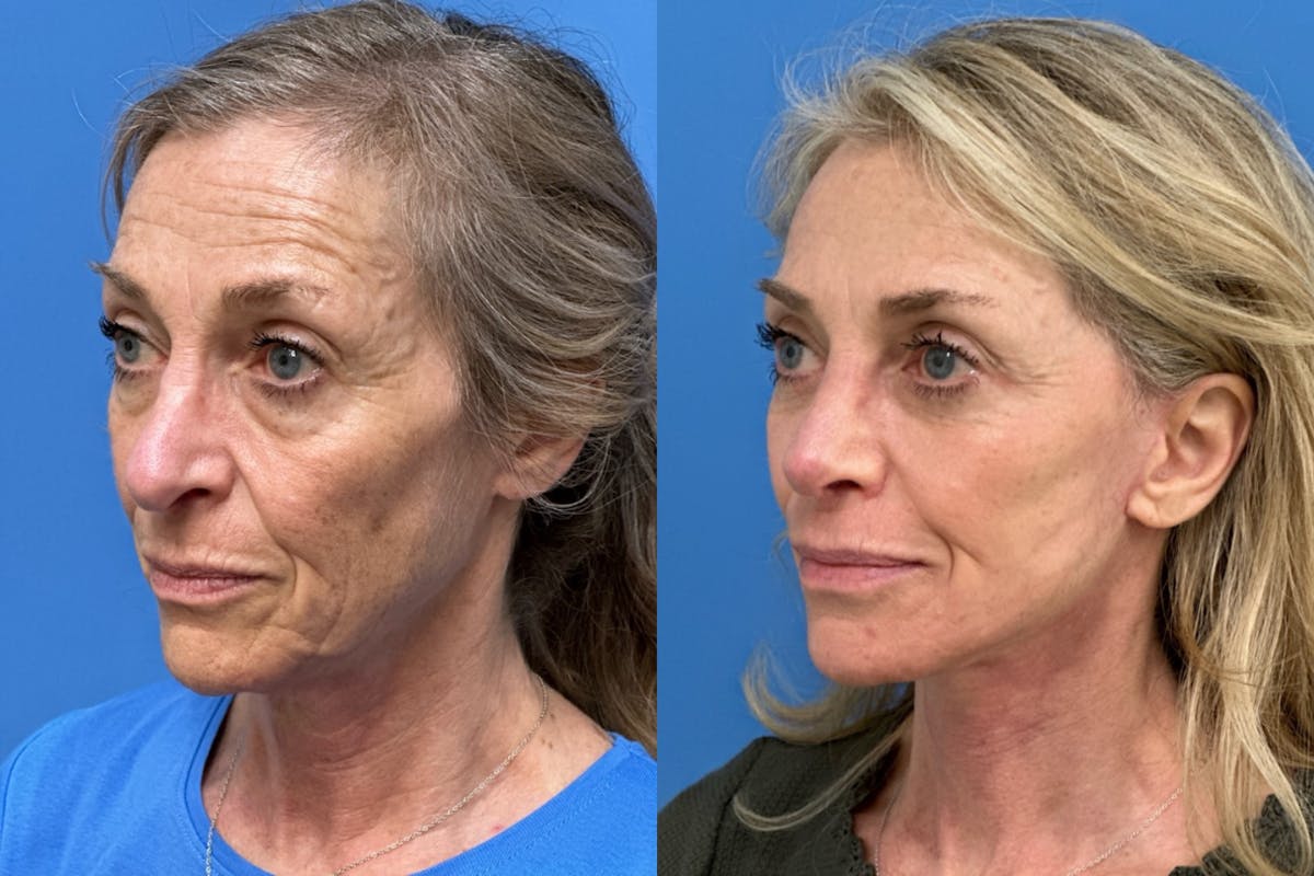 Facelift Before & After Gallery - Patient 198652 - Image 2